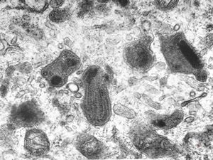 F,49y. | promelanosome F,49y. | promelanosome